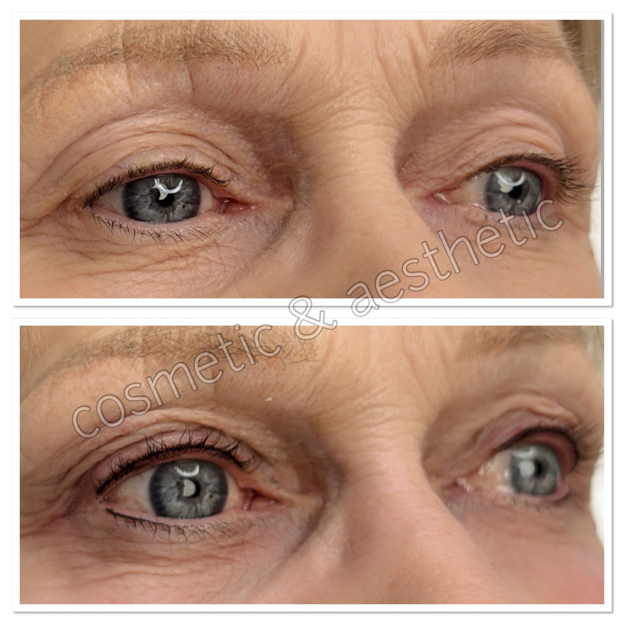 Wimpernkranzverdichtung Beispiel 3